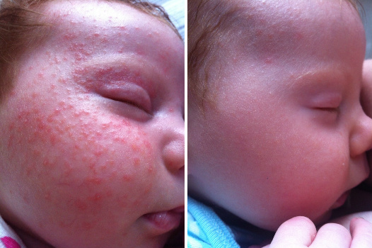 Baby With Facial Seborrheic Dermatitis Before & After