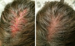 Severe Scalp Rash With Hair Loss Before & After